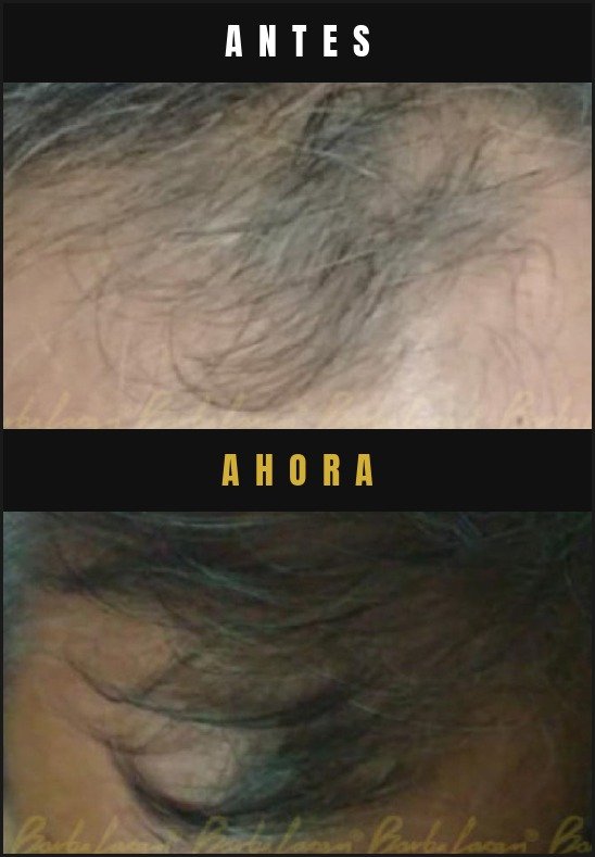 Caso real crecimiento de cabello Barba Larga