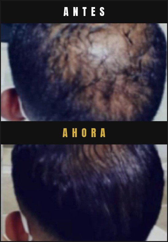 Caso real crecimiento de cabello Barba Larga