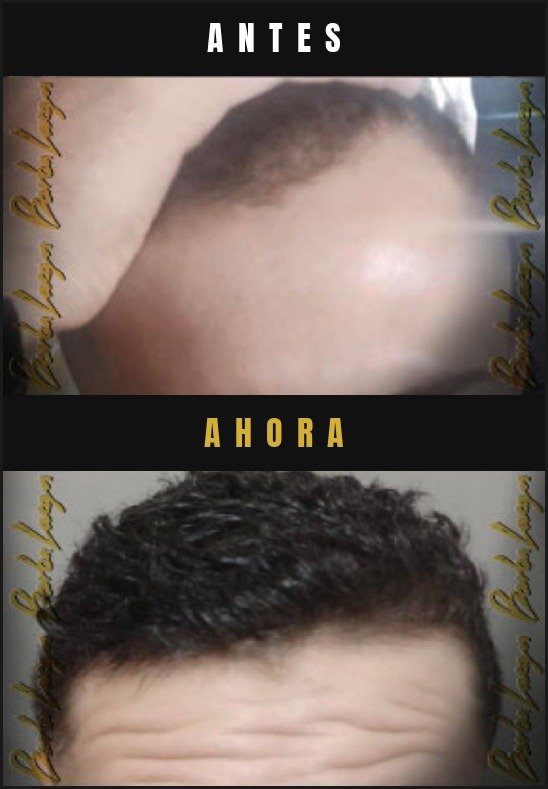 Caso real crecimiento de cabello Barba Larga