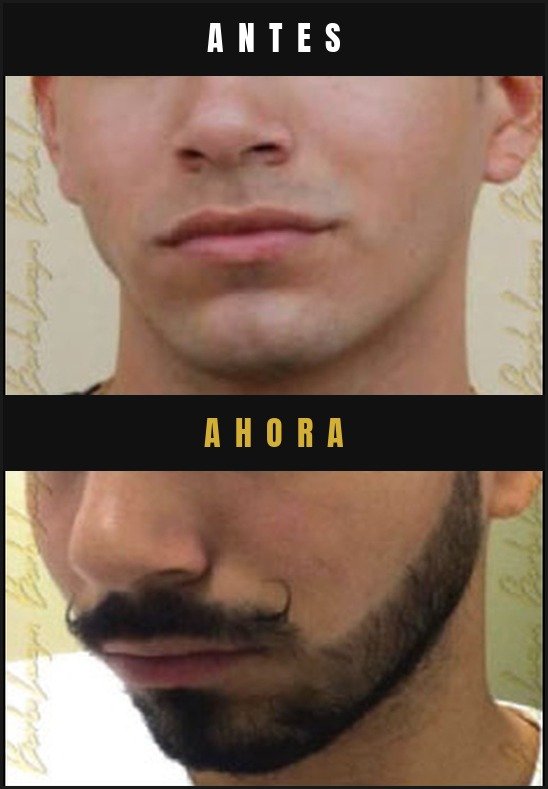 Caso real crecimiento de barba Barba Larga