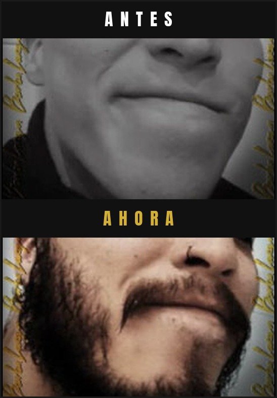 Caso real crecimiento de barba Barba Larga