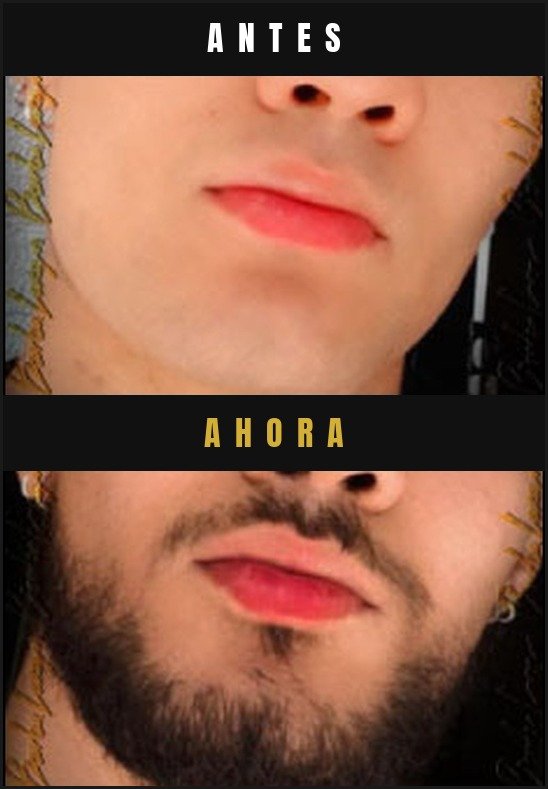 Caso real crecimiento de barba Barba Larga