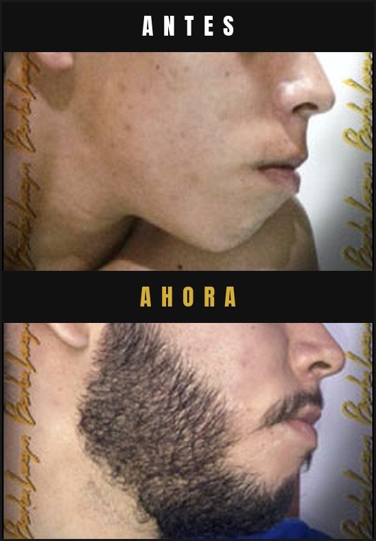Caso real crecimiento de barba Barba Larga