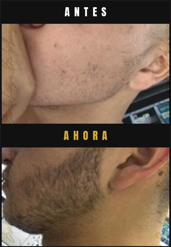 Caso real crecimiento de barba Barba Larga