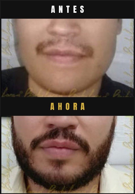 Caso real crecimiento de barba Barba Larga