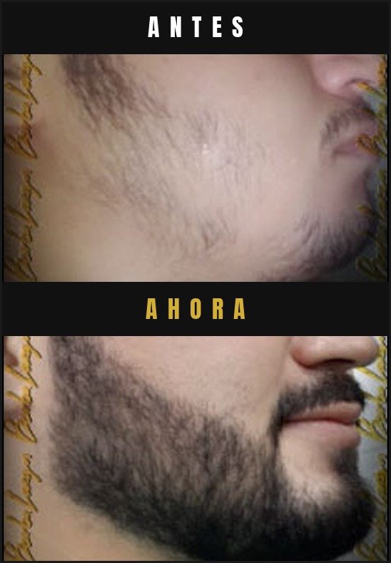 Caso real crecimiento de barba Barba Larga