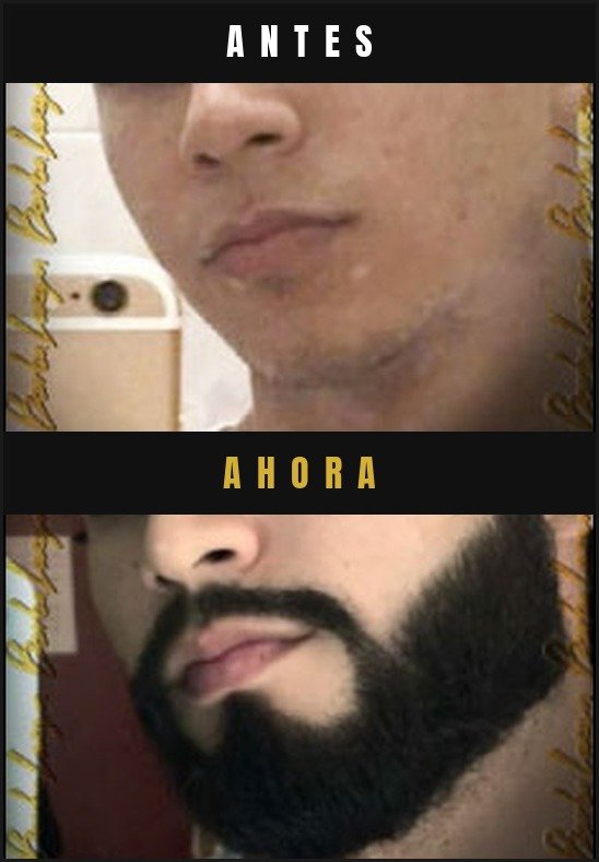 Caso real crecimiento de barba Barba Larga