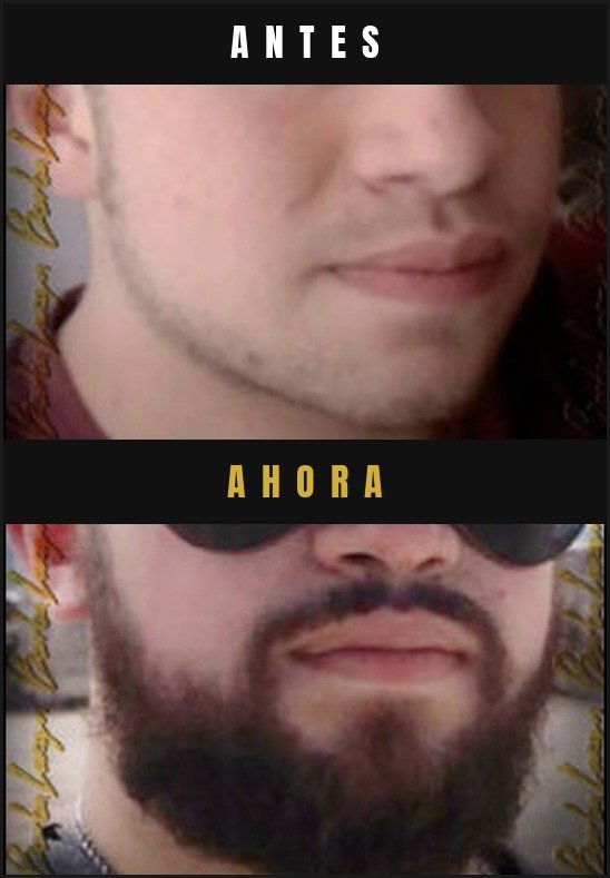 Caso real crecimiento de barba Barba Larga