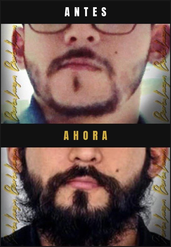 Caso real crecimiento de barba Barba Larga