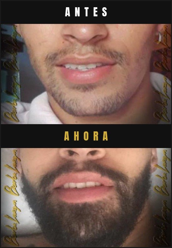 Caso real crecimiento de barba Barba Larga