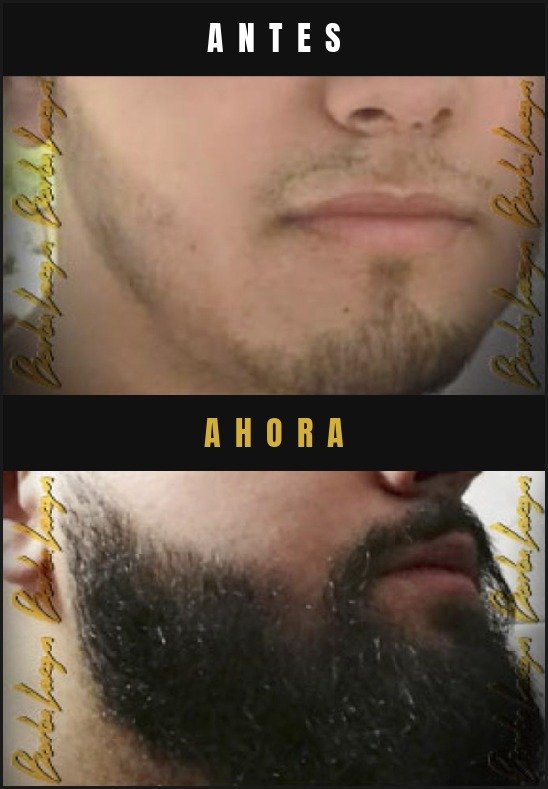 Caso real crecimiento de barba Barba Larga