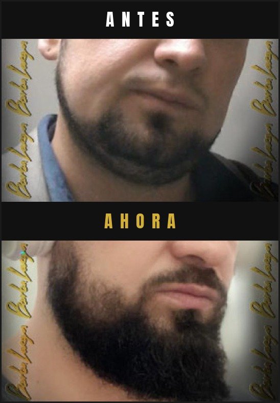 Caso real crecimiento de barba Barba Larga