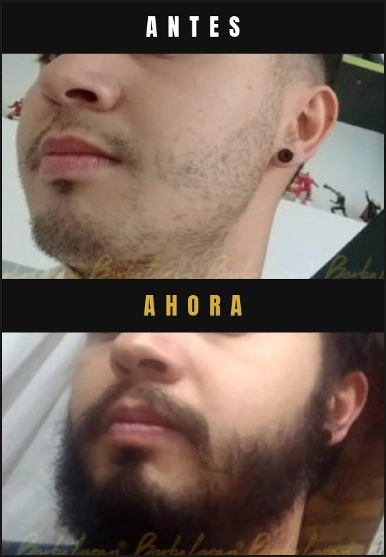Caso real crecimiento de barba Barba Larga