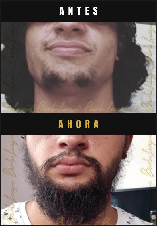 Caso real crecimiento de barba Barba Larga