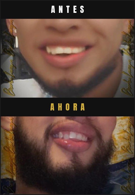 Caso real crecimiento de barba Barba Larga