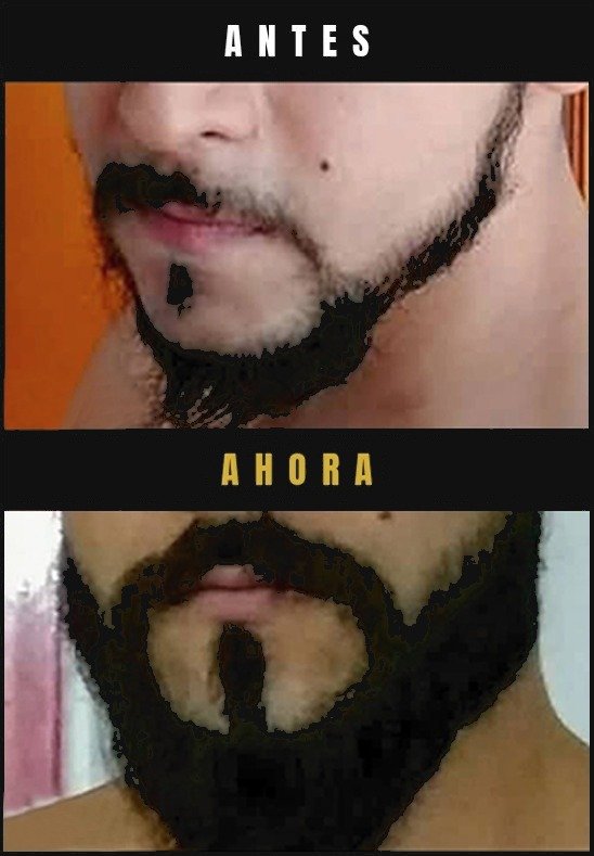 Caso real crecimiento de barba Barba Larga